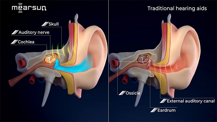 Hear Clearly, Stay Aware: Why Bone Conduction OTC Hearing Aids Are Different